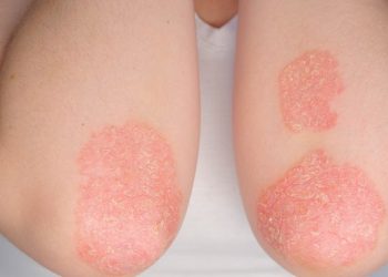 Psoríase. Foto: Divulgação