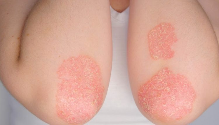 Psoríase. Foto: Divulgação