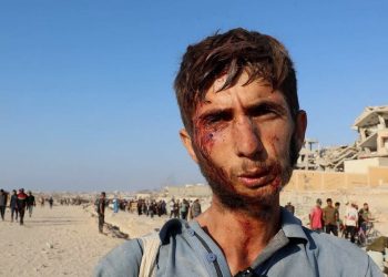 Um jovem de Gaza ferido no rosto ao tentar obter ajuda. Foto: ONU News