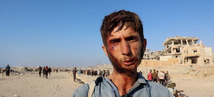 Um jovem de Gaza ferido no rosto ao tentar obter ajuda. Foto: ONU News