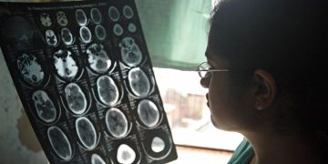 Um médico em Agra, na Índia, examina as imagens de tomografia cerebral de um paciente. Foto: OMS/Rajiv Kumar
