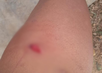 Vítima perfurada. (Foto: Divulgação/PC-AM)